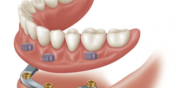 Atadent İmplantüstü (Overdenture) Protez