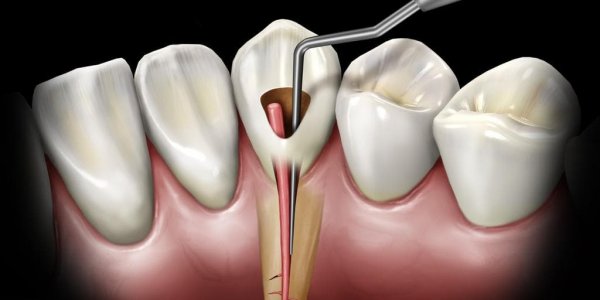 Balıkesir Endodonti